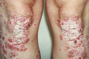schuppenflechte behandeln erscheinungsbild psoriasis