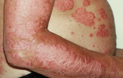 schuppenflechte behandeln psoriasis arm und bauch